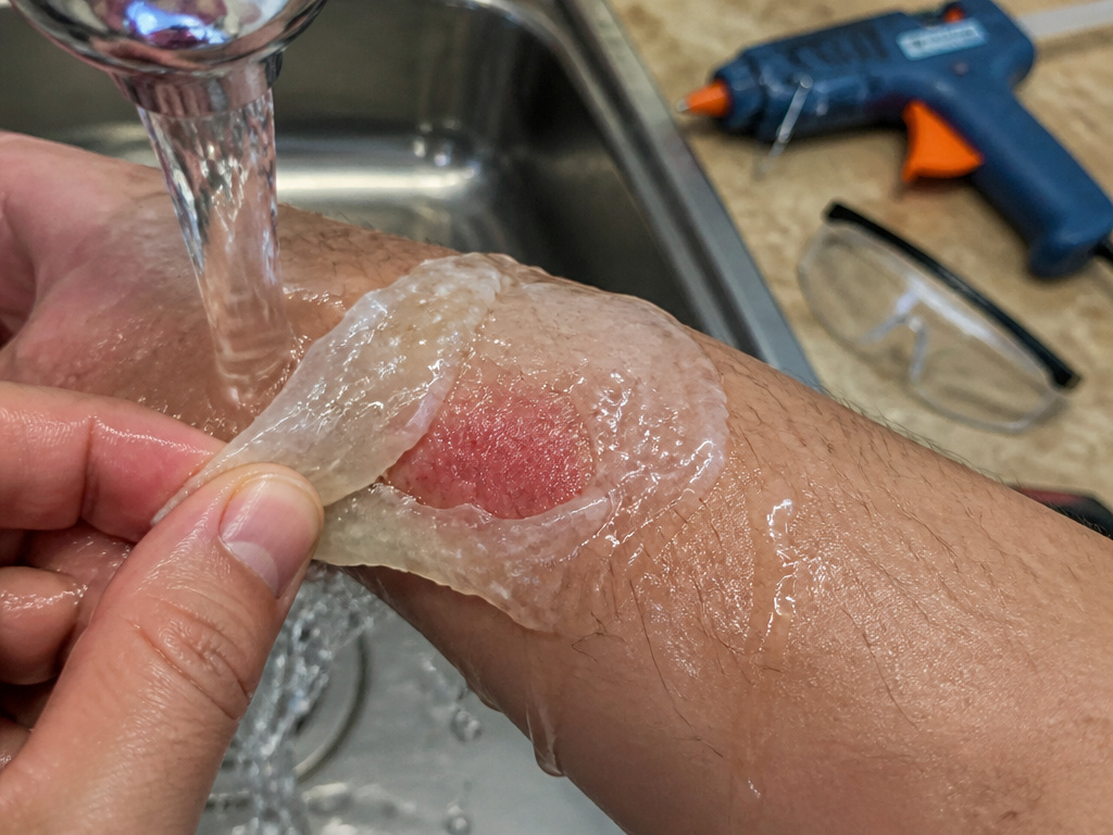 First aid for a hot glue burn: cooling skin under running water with glue attached.